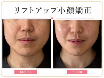 ビオエル(Bee'oele)の写真/リフトアップ小顔矯正でスッキリしたフェイスラインへ