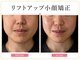 ビオエル(Bee'oele)の写真/リフトアップ小顔矯正でスッキリしたフェイスラインへ