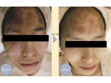 ザ フェース 京都御池店(THE FAITH)/お客様のお肌変化