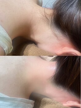 美容コルギサロン コハク(KOHAK)の写真/【うなじワックス＋光脱毛】自分では手が届かない箇所はプロにお任せ★薄着の季節に向けて自信溢れる肌に★