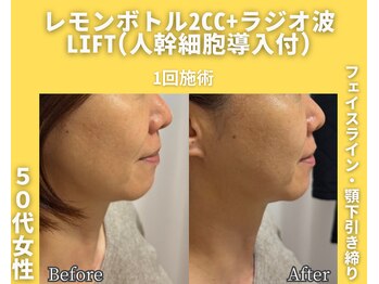 イーラボ 池袋店(e-LABO)/レモンボトル+ラジオ波Lift