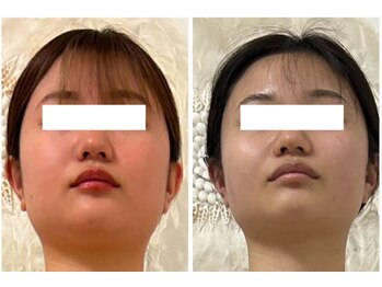 カレン(KAREN)/脂肪燃焼×セルゼロ#小顔