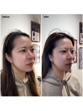 キャピタル(CAPITAL)/美脳小顔矯正　小顔　たるみ　