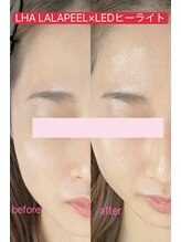 ドルチェナッツ ネオ 府内店(dolce nuts NEO)/ララピール＋新世代ヒーライト♪