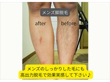 メンズ脱毛も大人気です！ヒゲ～全身どこでも脱毛出来ます！