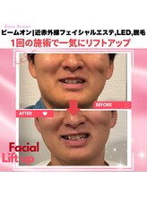 ビジュボーテ(Bijou Beaute)/近赤外線フェイシャルエステ,LED