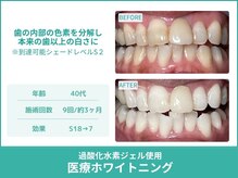 クレア(Crea)/【歯のホワイトニング症例写真】