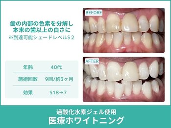 クレア(Crea)/【歯のホワイトニング症例写真】