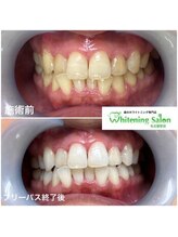 ホワイトニングサロン 名古屋駅店/【ホワイトニング施術例】