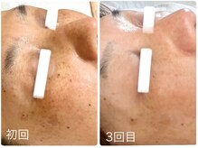 ポモナ 横浜馬車道店(Pomona)/シミ＆かんぱんも施術可能◎