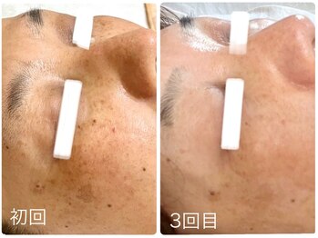 ポモナ 横浜馬車道店(Pomona)/シミ&かんぱんも施術可能◎