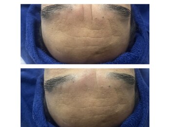 シルグラン(SIL gran)/しわ改善ゾンビマスク前後