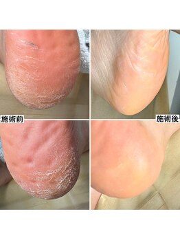 ベッレ マーニ/足裏角質ケア