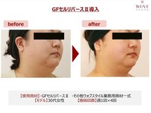 ブリエ/エレクトロポレーション導入