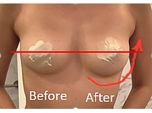 ルミエール(Lumiere)/【倉敷市】バストアップ施術事例