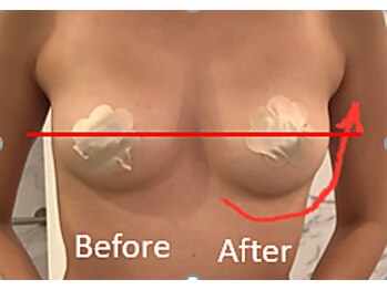 ルミエール(Lumiere)/【倉敷市】バストアップ施術事例