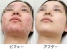 【韓国最新】究極のエイジング!ハーブピーリング TROIPEEL初めての方