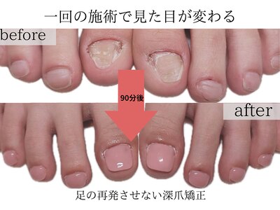 栃木県初即日見た目が変わる深爪矯正、美爪再生リプロネイル導入