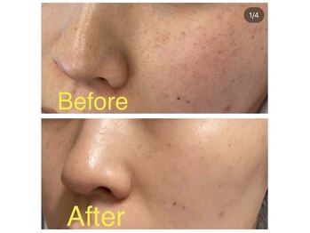 ロゼッティ(ROSETTY)/「シルクライト」LED照射30分☆