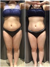 アイスタイル(i-style)/脂肪冷却/痩身ダイエット/泉大津