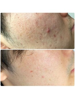 ニカ(NiCA)/2週に1度 5回照射