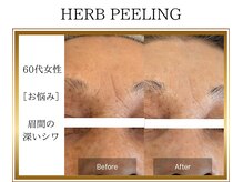 ロージー(ROSY)/ハーブピーリング/阿南/徳島