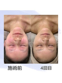 ニコ(25)/プラウェーブ