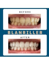 ブランリエ 天王寺阿倍野店(BLANRILLER)/セルフホワイトニング