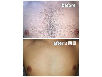 ノノケケ(NONOKEKE)/【メンズ脱毛】　全身脱毛