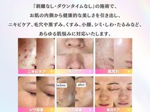 エステが初めての方もピーリング専門店にお任せください!