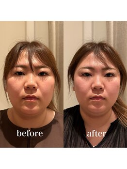 ハリノヒ 大阪院/フェイスラインを引き上げ美容鍼