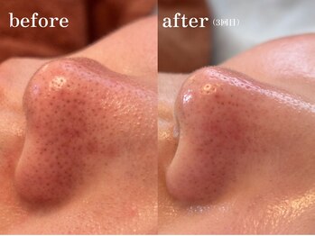 ベレミアム(Bellemium)/毛穴洗浄×ハーブピーリング