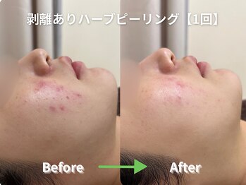 リソルバイスリール(Re:sol by sourire)/毛穴洗浄・ハーブピーリング専門