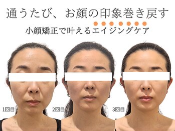 レジスタ(REGISTA)の写真/【くっきり線が入る前に】欲しい所に膨らみを+不要なたるみを予防するプロのテクニックでほうれい線解消!