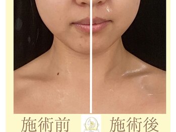 リコ(Rico)の写真/[何歳からでも小顔になれる]Rico式造顔マッサージ!1回の効果はもちろんその後もリバウンドしない小顔作りを