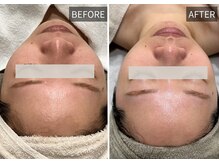 エナ(ENA)/小顔ケア　Before→ After