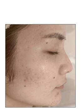 ノーブル 新宿南口(NOBLE)/ハーブピーリング専門新宿