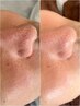 [目指せノーファンデ肌☆]毛穴、シミ改善＋顔脱毛1回￥20000→¥18000(100分)