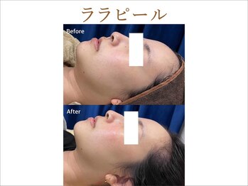 ティアム バイ テトテ 神戸三宮(TIAM by tetote)/ララピール