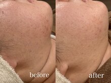 エルティナ(#LTIENA)/クリスティーナハーブピーリング