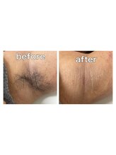 レアレアケー(Lea Lea_K)/レディース脇 ワックス脱毛