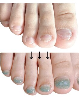 スマイルニコ(smile nico)/深爪矯正　自爪育成