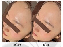 アン ビューティー(ann beauty)/施術1回【症例写真】20代女性
