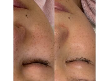 レア(le'a)/シミにもプロセルフェイシャル