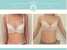 美人バスト 新潟店/ 【バストアップ★育乳】症例