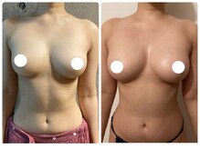 ハイファイブ(Hi-Five)/バストアップ/施術10回