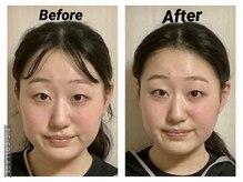 ショウフェイスデザイン(Sho Face Design)/《小顔矯正》ビフォーアフター