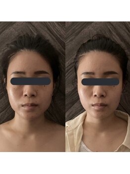 ハイコガオ 中崎町店(HIKOGAO)/小顔矯正