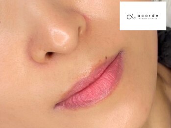 アコルデサロン 三宮(ACORDE salon)の写真/*ローマピンク正規店*国家資格保持者のローマピンクで本気の黒ずみ改善！美白/角質ケア