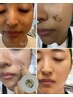 【しっかり派に】最新シミケア≪30分間しみ集中ケア/40~60個目安≫